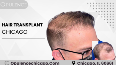 Hair Transplant Chicago