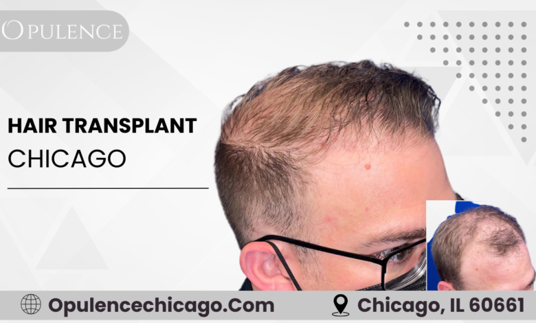 Hair Transplant Chicago