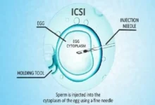 icsi male infertility