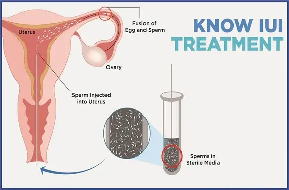 iui treatment