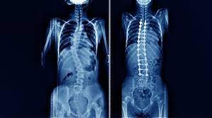 Best Scoliosis Doctor in Kerala
