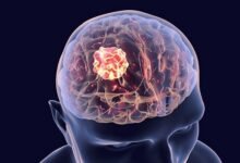 Brain Tumor Surgery Cost in India
