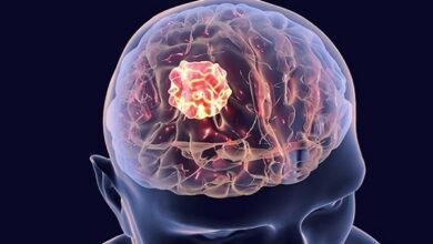 Brain Tumor Surgery Cost in India