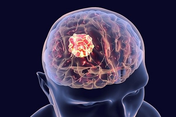 Brain Tumor Surgery Cost in India