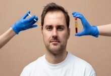 PRP Treatment for Hair Loss